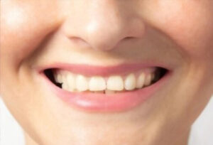 Broken Teeth Repair
